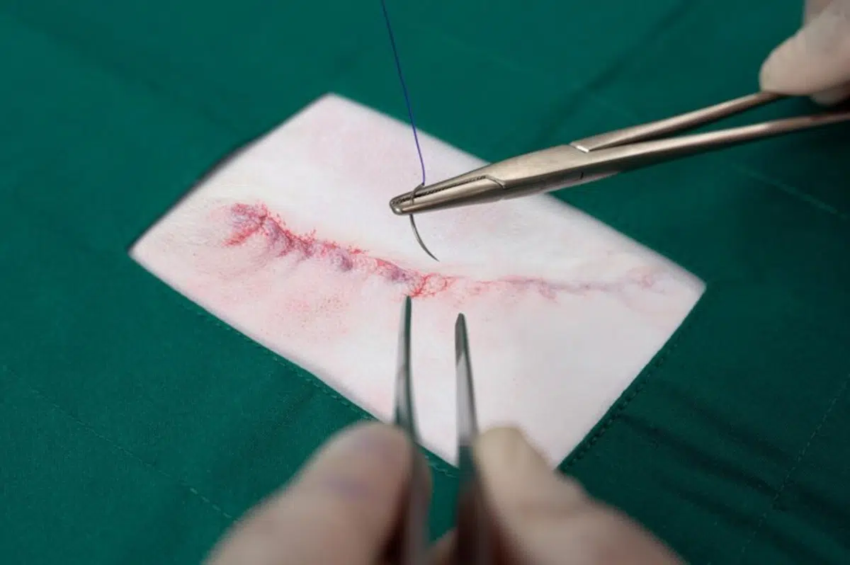 infection point de suture