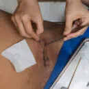 suture résorbable