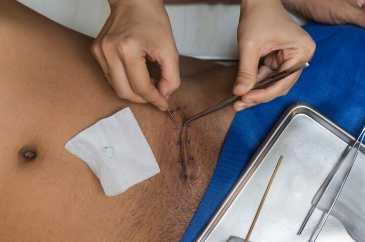 suture résorbable